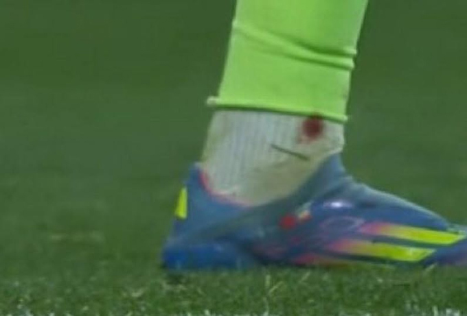 Mắt cá chân của Yamal tứa máu sau pha vào bóng của Lenglet